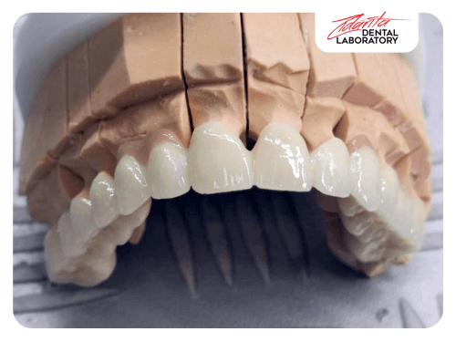 Coroană dentară metalo-ceramică
