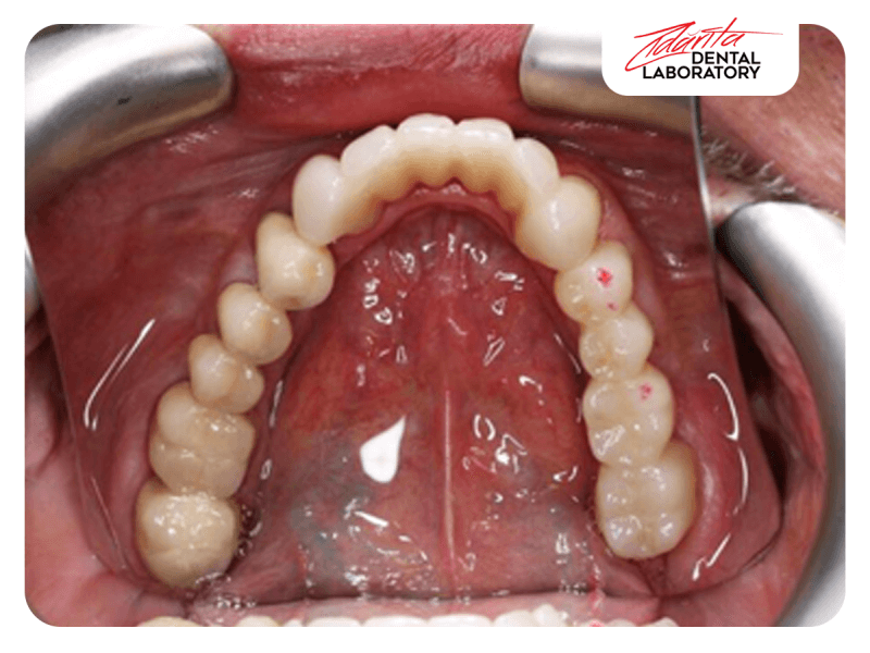 Lucare inferioara full zirconiu Amann G si modele printate 3d